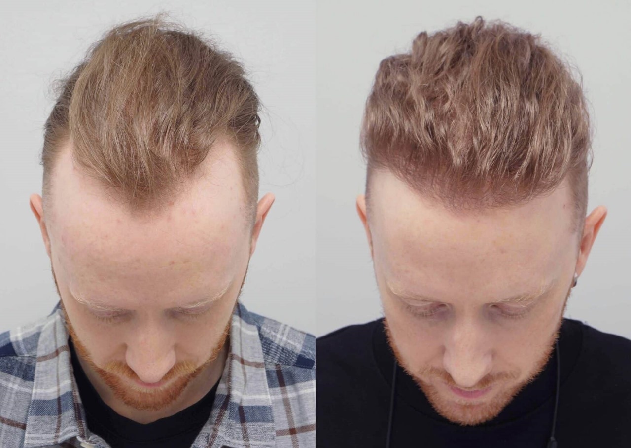 Restore Your Hairline with a Hair Transplant London Specialists Trust