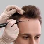 Get Your Confidence Back with a Hair Transplant London Treatment