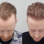 Restore Your Hairline with a Hair Transplant London Specialists Trust